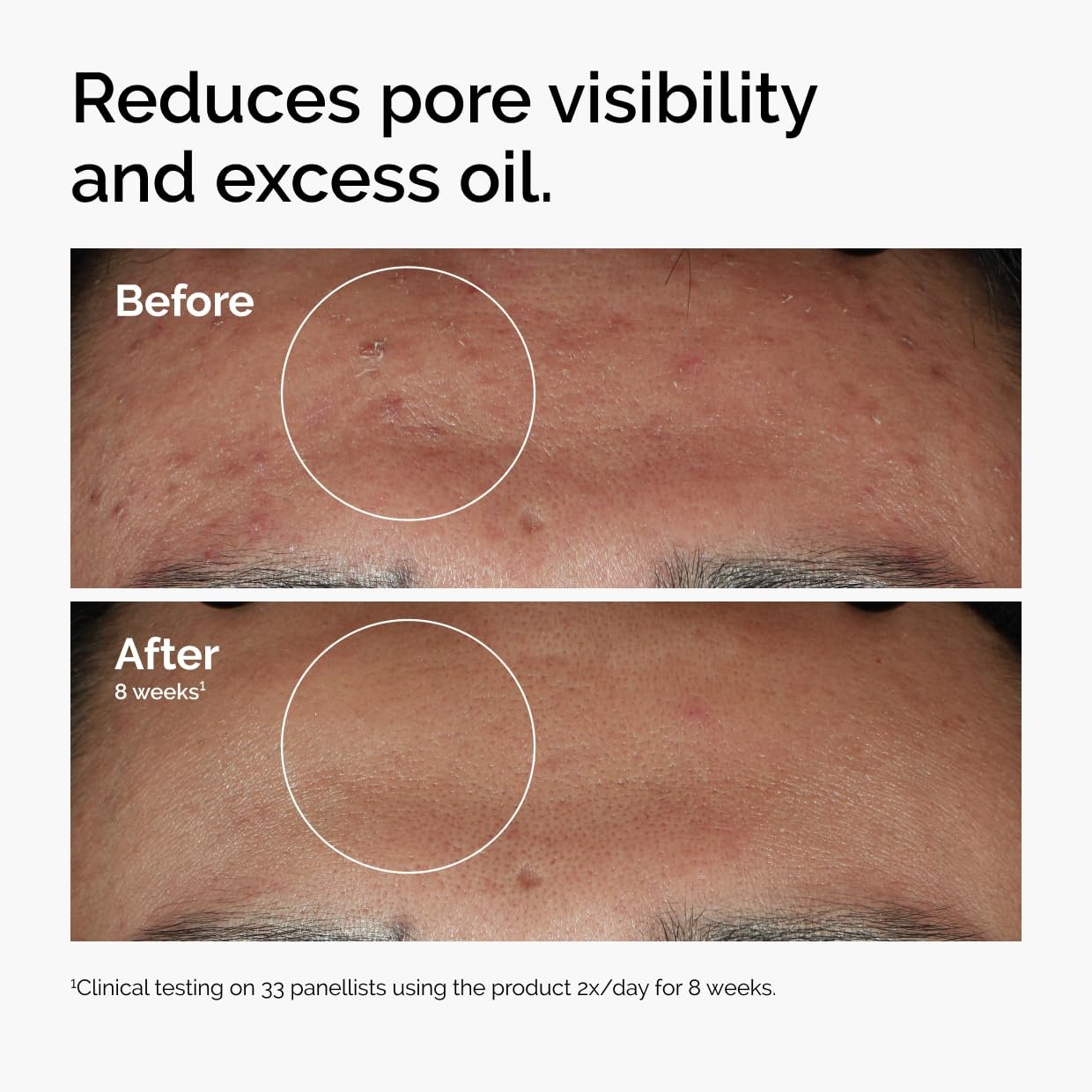 The Ordinary Niacinamide 10% + Zinc 1%, Brightening & Smoothing Serum - Image 5